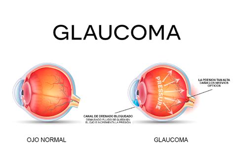 o que é glaucoma